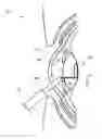 Fig. 01 - Capsulotomy repair device and method for capsulotomy repair