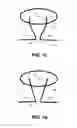 Fig. 03 - Capsulotomy repair device and method for capsulotomy repair