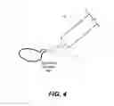 Fig. 09 - Capsulotomy repair device and method for capsulotomy repair
