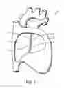 Fig. 02 - Removable intracardiac RF device