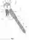 Fig. 02 - Anchor-in-anchor system for use in bone fixation