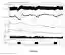 Fig. 18 - Brown adipose tissue utilization through neuromodulation
