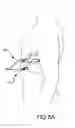 Fig. 12 - CARDIOVERSION ELECTRODE