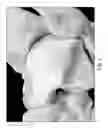 Fig. 06 - Articular Surface Implant