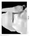 Fig. 07 - Articular Surface Implant