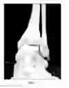 Fig. 08 - Articular Surface Implant