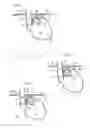 Fig. 02 - Methods and instruments for treating GERD and hiatal hernia