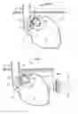 Fig. 07 - Methods and instruments for treating GERD and hiatal hernia