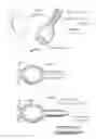 Fig. 35 - Methods and instruments for treating GERD and hiatal hernia
