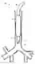 Fig. 01 - Self-sizing adjustable endotracheal tube