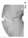 Fig. 23 - Osteosynthesis with nano-silver