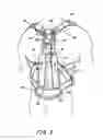 Fig. 04 - ADJUSTABLE POSTERIOR SPINAL ORTHOSIS