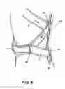 Fig. 06 - ADJUSTABLE POSTERIOR SPINAL ORTHOSIS