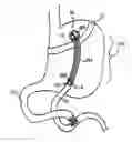 Fig. 01 - Devices, systems, and methods for achieving magnetic gastric bypass