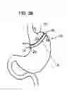 Fig. 06 - Devices, systems, and methods for achieving magnetic gastric bypass