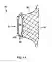 Fig. 08 - Devices, systems, and methods for achieving magnetic gastric bypass