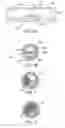 Fig. 02 - Cryotherapy method for detecting and treating vulnerable plaque