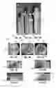 Fig. 04 - Nanosecond pulsed electric field parameters for destroying tumors with a single treatment