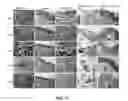Fig. 10 - Nanosecond pulsed electric field parameters for destroying tumors with a single treatment