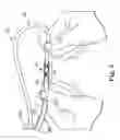 Fig. 06 - Systems and Methods for Implanting Medical Devices