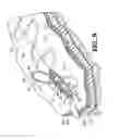 Fig. 07 - Subcutaneous sinusoidal wound closure utilizing one-way suture