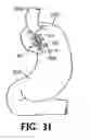 Fig. 22 - Subcutaneous sinusoidal wound closure utilizing one-way suture
