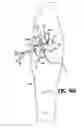 Fig. 35 - Subcutaneous sinusoidal wound closure utilizing one-way suture