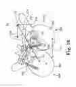 Fig. 06 - DEFORMITY ALIGNMENT SYSTEM WITH REACTIVE FORCE BALANCING
