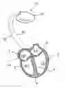 Fig. 01 - Medical device for stimulation of the HIS bundle