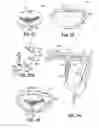 Fig. 09 - HEART VALVE REPAIR APPARATUS AND METHODS