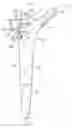 Fig. 01 - Joint implant