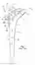 Fig. 02 - Joint implant