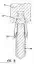 Fig. 08 - Dental implant with interlocking and centering threads