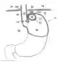 Fig. 01 - Apparatus for treating GERD