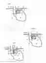 Fig. 02 - Apparatus for treating GERD