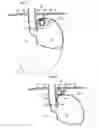 Fig. 04 - Apparatus for treating GERD