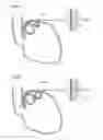 Fig. 06 - Apparatus for treating GERD