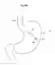 Fig. 28 - Apparatus for treating GERD