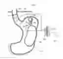 Fig. 33 - Apparatus for treating GERD