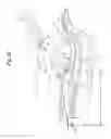 Fig. 04 - Methods and apparatuses for navigating the subarachnoid space