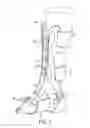 Fig. 02 - Adjustable splinting device