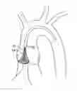 Fig. 01 - Aortic Valve Repair