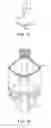 Fig. 08 - Aortic Valve Repair