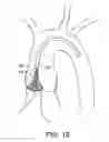 Fig. 11 - Aortic Valve Repair