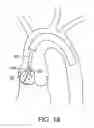 Fig. 12 - Aortic Valve Repair