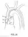 Fig. 13 - Aortic Valve Repair