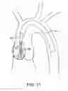 Fig. 14 - Aortic Valve Repair