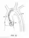 Fig. 15 - Aortic Valve Repair
