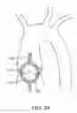 Fig. 17 - Aortic Valve Repair