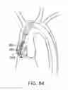 Fig. 37 - Aortic Valve Repair